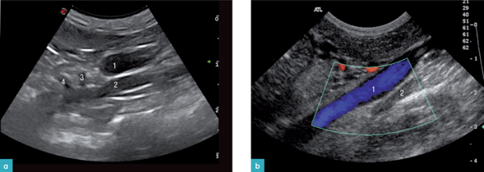 左肾上腺位于主动脉的腹侧