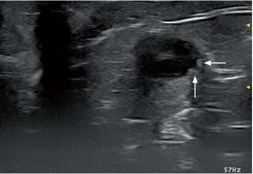 输尿管凸起,膀胱三角区的斜横截面视图 输尿管凸起,膀胱三角区的斜横截面视图