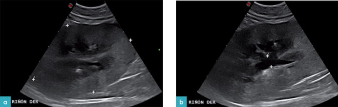 急性肾损伤 急性肾损伤