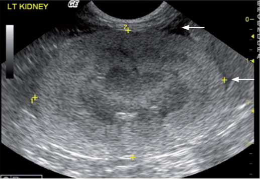急性肾损伤患者的肾脏纵向视图 急性肾损伤患者的肾脏纵向视图