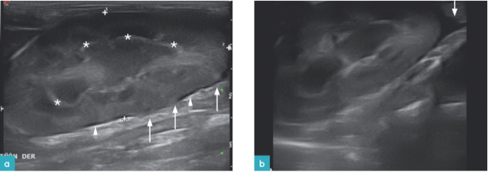 患有传染性腹膜炎的2岁雌性猫右肾的纵向视图