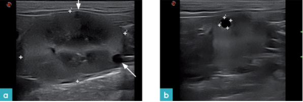 患有多囊肾病的13岁雌性波斯猫的肾脏