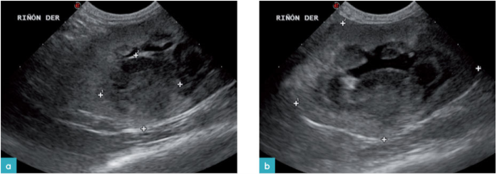 肾淋巴瘤 肾淋巴瘤