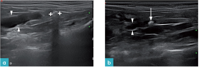 从尾部到结石,输尿管不再出现扩张 从尾部到结石,输尿管不再出现扩张