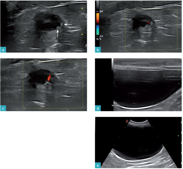 正常的膀胱（a）膀胱的斜位截面，可见膀胱三角区。箭头处为两个小的圆形凸起为输尿管乳头的切口。（b）为左侧输尿管乳头的尿液彩色射流