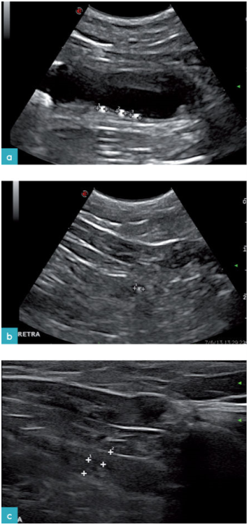 膀胱炎，尿道炎的患猫，存在有膀胱和尿道结石。