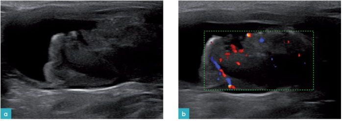排尿困难患猫的膀胱矢状面。b.可见肿块的血供丰富