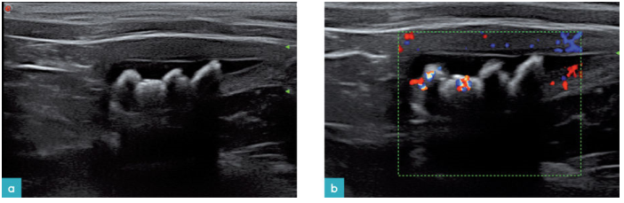 4颗中等大小的结石伴有清洁声影（b）彩色多普勒置于结石之上会产生彩色的闪烁伪影。