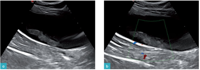 膀胱内的血凝块。膀胱内多处受损，显示为膀胱的矢状面。