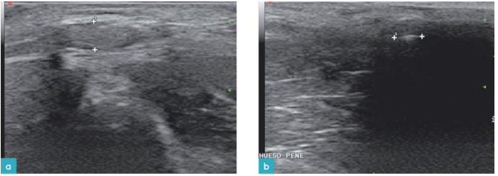 会阴部的矢状面