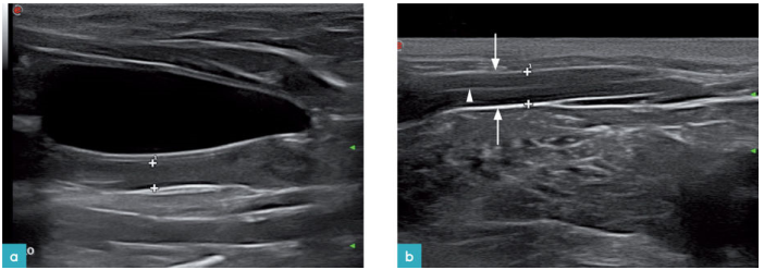 一只7岁的健康母猫的子宫体和右侧子宫角矢状面观