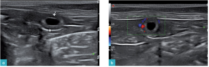 妊娠16天的子宫影像（a）子宫影像显示为一直径小于6mm，充满液体的圆形区域，子宫角内有多个胎囊。