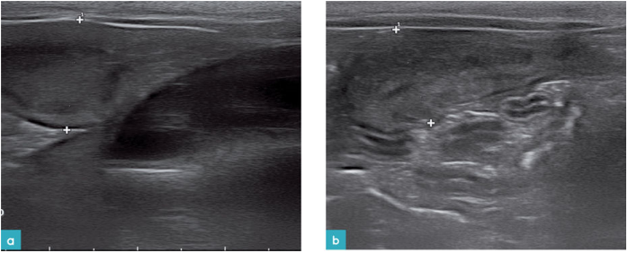 一只分娩后不久的5岁母猫子宫超声图。