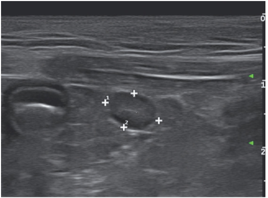 一只怀疑隐睾的三岁公猫，图为其腹部尾侧的矢状面