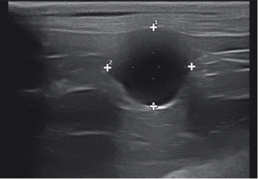 一只17岁母猫有卵巢囊肿，可见一高回声薄壁包裹下的无回声囊状结构（光标之间），右侧卵巢区域后方回声增强。