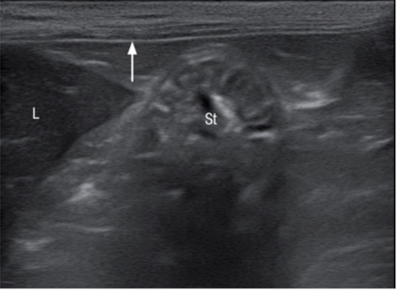 壁层腹膜(箭头)是腹壁上最靠内侧的一条高回声亮线 壁层腹膜(箭头)是腹壁上最靠内侧的一条高回声亮线