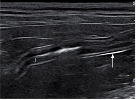 脏层腹膜(白色箭头)呈现高回声亮线,是空肠的最外一层壁 脏层腹膜(白色箭头)呈现高回声亮线,是空肠的最外一层壁