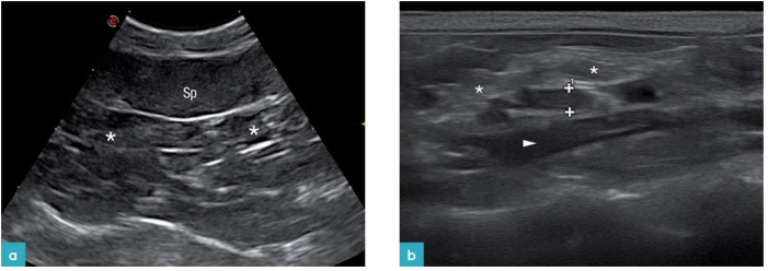 腹壁(星号)是混合回声的。比脾脏的回声升高 腹壁(星号)是混合回声的。比脾脏的回声升高