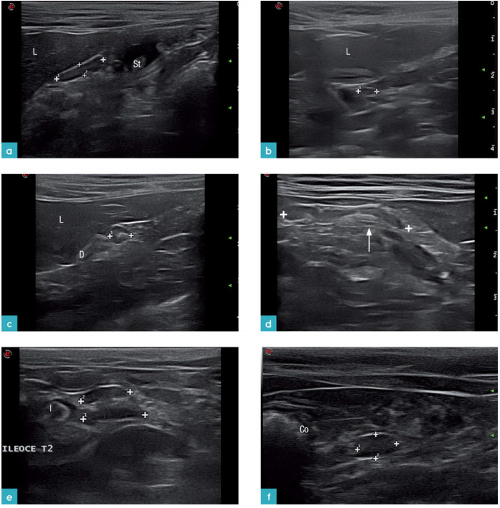 内脏淋巴结。大部分是低回声圆形或卵圆形的淋巴结 内脏淋巴结。大部分是低回声圆形或卵圆形的淋巴结