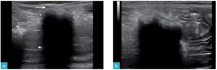 肠系膜上有手术后遗留的纱布块