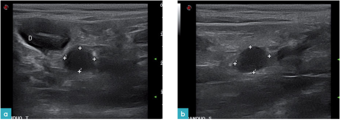 肠道淋巴瘤的病例，横截面和矢状面
