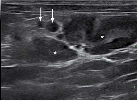 肠道淋巴瘤的病例