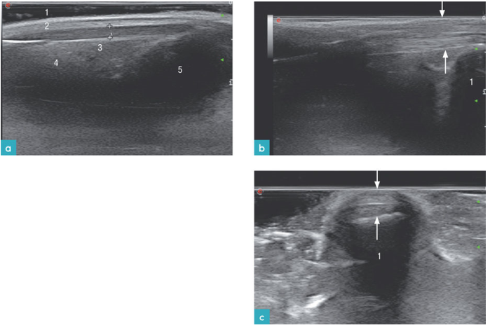 胫骨关节水平的股四头肌肌腱或髌骨韧带
