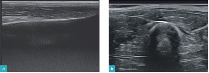 将探头放在股部头侧获得股骨长轴观。