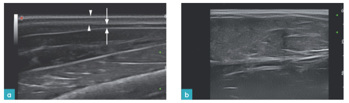 冈上肌的长轴观