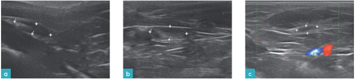 背侧颈浅淋巴结的矢状面