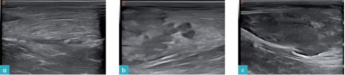 股二头肌脓肿，股部外侧长轴观