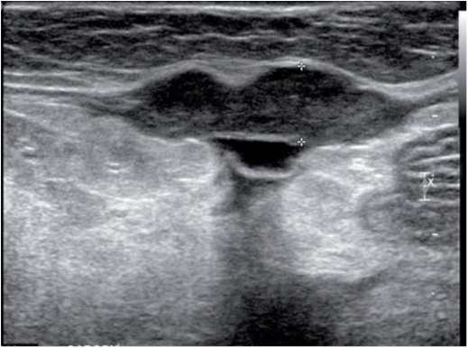 一只胰腺癌患猫的腹部长轴观