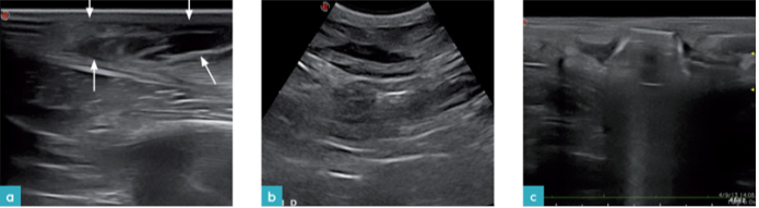 创伤引起的皮下组织炎症 创伤引起的皮下组织炎症