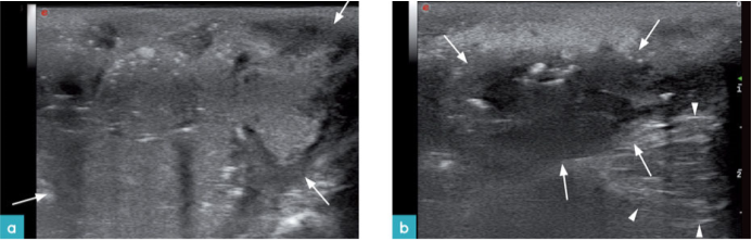 会阴部皮下脓肿 会阴部皮下脓肿