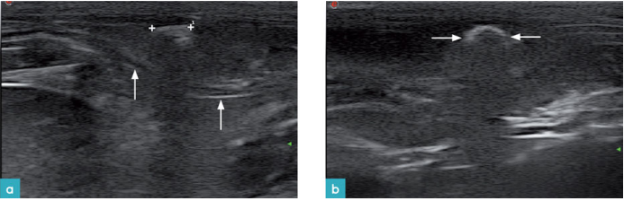 枪伤造成腹壁的贯穿伤 枪伤造成腹壁的贯穿伤