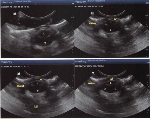 使用增距垫进行眼睛的超声扫查，Medial内侧(鼻侧)、AC眼前房、V玻璃体、L晶状体。其中第4张图箭头标出了脱落的视网膜，呈现“飞鸟征”，由于视网膜在眼内固定牢固的三个地方不易脱落，而其它地方容易脱落而形成了这样的典型征象。