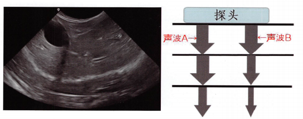 左图中胆囊远场回声增强。右图:声波B显示的是未经过胆囊的声波，由于逐步衰减，声波到远场越来越少，所以机器对远场进行了逐级补充，使最终的图像远场和近场明暗度接近。声波A显示的是经过胆囊的其中一个声波，由于在胆囊内声波没有衰减，所以到达胆囊远场的声波更多，造成远场的回声增强，这并不是远场的结构变化所致，而是到达远场的声波增多导致的。