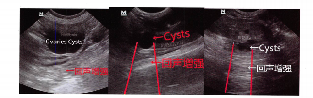 左图卵巢囊肿，中图肾脏囊肿，右图前列腺囊肿。 OVARIES 卵巢，Cysts 囊肿