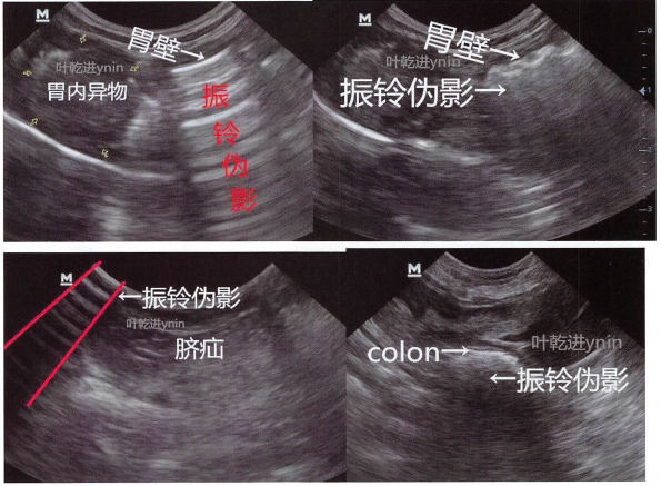 几个振铃伪影实例:图一图二:是胃内气体形成的，有气体就会有振铃伪影，不同的扫查角度，会有不同影像，但都是远场不可见。图三:扫查脐疝时探头接触不良，相当于探头直接在空气中，也会形成振铃伪影。探头未接触动物体的时候，屏幕上显示的就是振铃伪影。图四:结肠内有气体，气体与肠壁的声阻抗值差异很大形成了强烈反射(也可理解为结肠内的粪便声阻抗值与肠壁差异很大所以形成了强烈反射)此外本书气肿性膀胱炎部分的案例中膀胱壁中的气体也形成了气肿性膀胱炎。