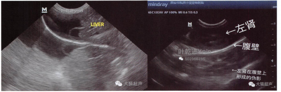 作为肝膈处镜像伪影，右为肾脏在腹壁上形成的镜像伪影。