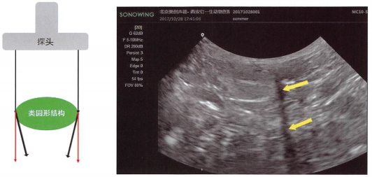 左图:由于圆形结构边缘很光滑，所以把一部分原本应该直线传播的声波(红色箭头)折射到内侧(黑色箭头)，导致黑色箭头和红色箭头之间的区域没有声波到达，也就形成了声影。右图:腹腔内隐睾也是一个圆形的结构，在旁边出现了侧边声影(黄箭头示)。