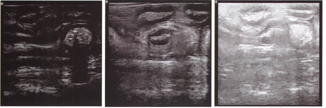 不合适的增益设置会导致图像细节丢失。左图增益过小，右图增益过大，中图增益设置恰 当。