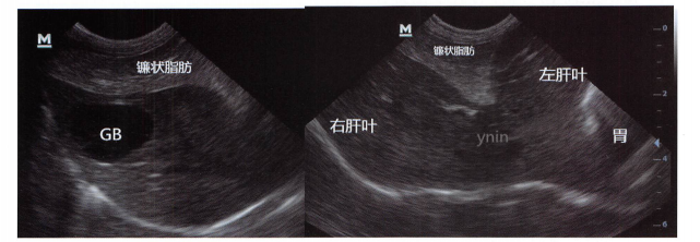 镰状脂肪是三角形的强回声,其充满脂肪所以呈现粗糙颗粒的强回声,突起于肝脏的左部和右部之间。将肝脏分为左部和右部。 镰状脂肪是三角形的强回声,其充满脂肪所以呈现粗糙颗粒的强回声,突起于肝脏的左部和右部之间。将肝脏分为左部和右部。