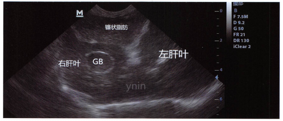 这是另一只狗的正常镰状脂肪。图中标识的右肝叶、左肝叶叫做右部、左部更为确切。 这是另一只狗的正常镰状脂肪。图中标识的右肝叶、左肝叶叫做右部、左部更为确切。