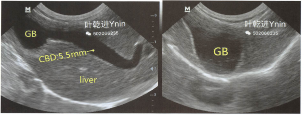一只老年犬呕吐、黏膜黄染,超声检查发现胆囊(GB)高度充盈(右图),总胆管CBD严重扩张(5.5mm)。右图还可看到胆囊的镜像伪影在膈的另一侧。 一只老年犬呕吐、黏膜黄染,超声检查发现胆囊(GB)高度充盈(右图),总胆管CBD严重扩张(5.5mm)。右图还可看到胆囊的镜像伪影在膈的另一侧。