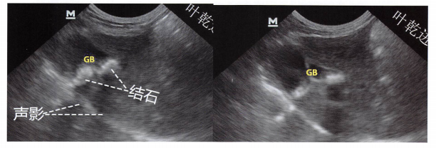 一只成年加菲猫,呕吐,超声发现胆结石。GB:胆囊. 一只成年加菲猫,呕吐,超声发现胆结石。GB:胆囊.