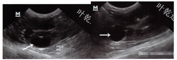 一只喜马拉雅猫的肾脏出现无回声区(大箭头所示),远场可见回声增强(小箭头所示)可以确认这是囊肿。需要与正常的肾脏髓质相区分,髓质是低回声,没有远场回声增强的特征。而且髓质大小相对均匀。 一只喜马拉雅猫的肾脏出现无回声区(大箭头所示),远场可见回声增强(小箭头所示)可以确认这是囊肿。需要与正常的肾脏髓质相区分,髓质是低回声,没有远场回声增强的特征。而且髓质大小相对均匀。