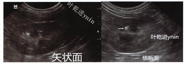 6岁公贵宾犬,肾盂憩室出现高回声光斑后伴声影,(矢状面光标间),横断面白色箭头所示。如正文所述,超声不能鉴别其性质,X光确认其为肾结石。此外此犬还发现了膀胱结石、尿道结石。这将在膀胱和尿道章节中进行论述。 6岁公贵宾犬,肾盂憩室出现高回声光斑后伴声影,(矢状面光标间),横断面白色箭头所示。如正文所述,超声不能鉴别其性质,X光确认其为肾结石。此外此犬还发现了膀胱结石、尿道结石。这将在膀胱和尿道章节中进行论述。