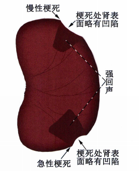 肾脏梗死示意图 肾脏梗死示意图