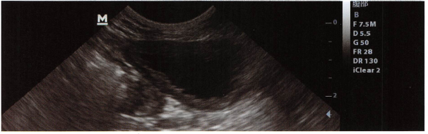 黏膜层增厚,内壁不光滑。慢性膀胱炎。 黏膜层增厚,内壁不光滑。慢性膀胱炎。